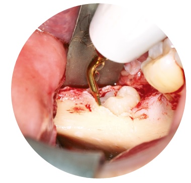 Насадка SG17 до VarioSurg3, SG17